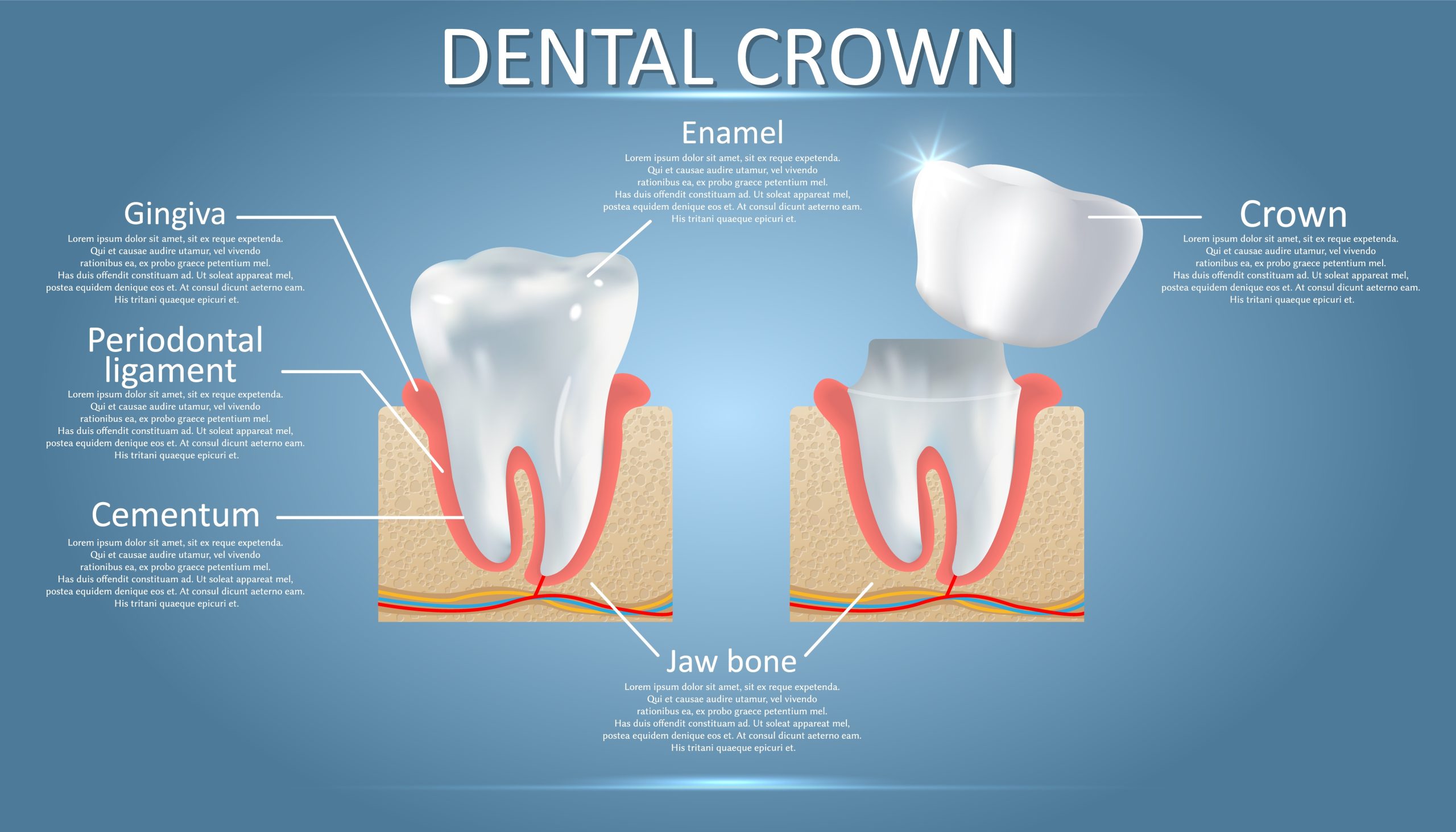 cracked tooth crown needed